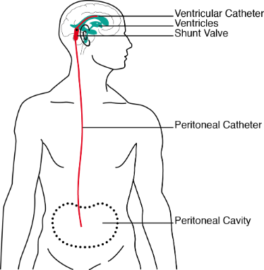 Basic shunt design