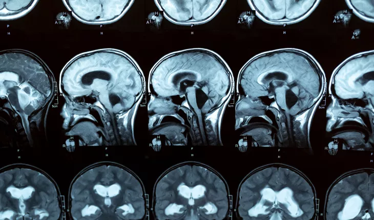 Hydrocephalus scans