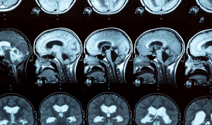 Hydrocephalus scans