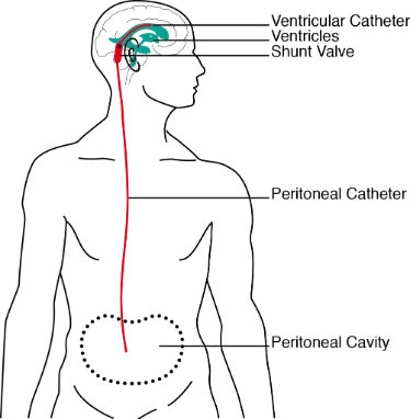 Basic shunt design